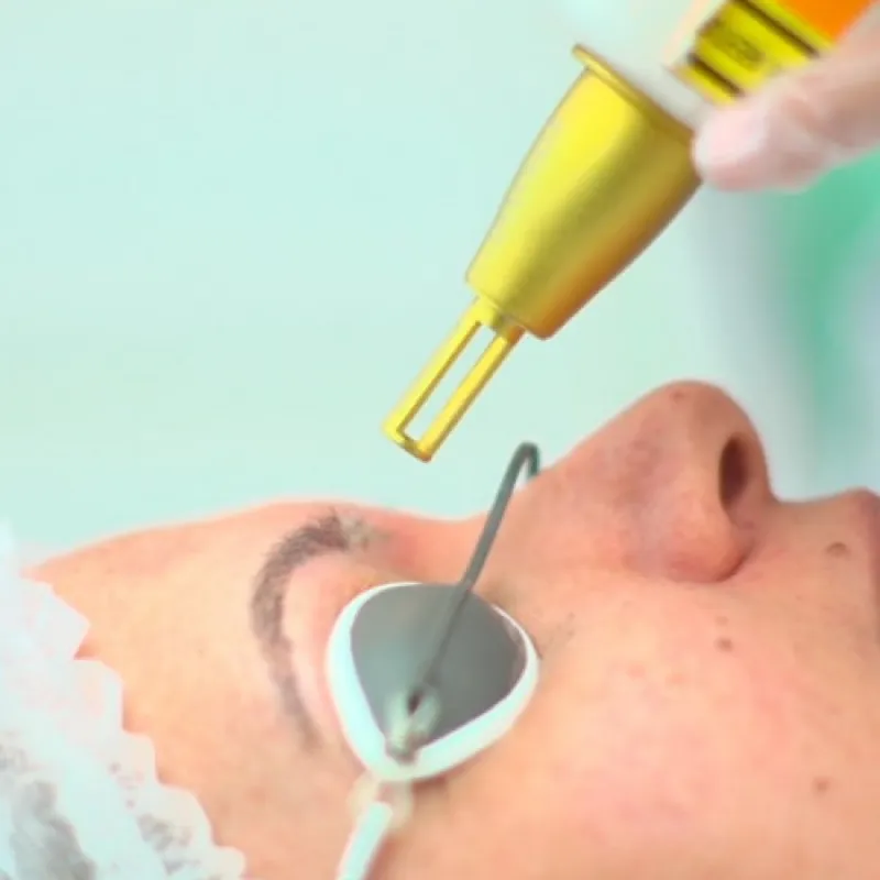 cursos de depilação a laser